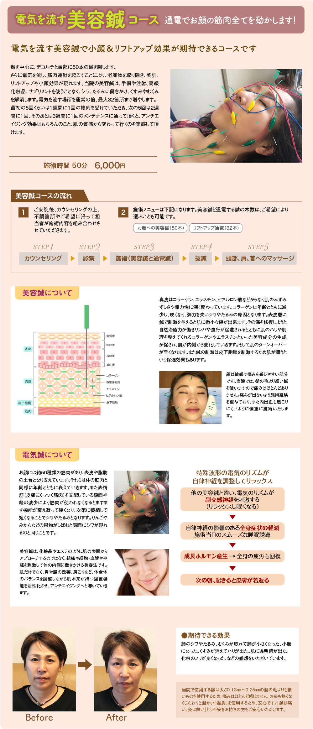 美容鍼 電気を流す美容鍼