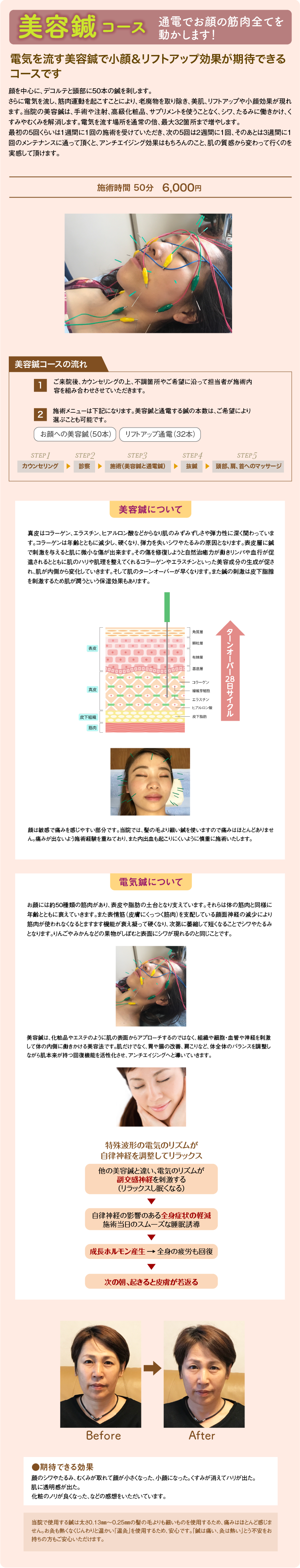 美容鍼 電気を流す美容鍼