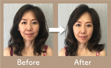 美容鍼施術前と施術後