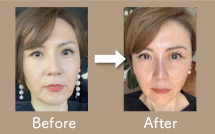 鍼灸と気功のセット